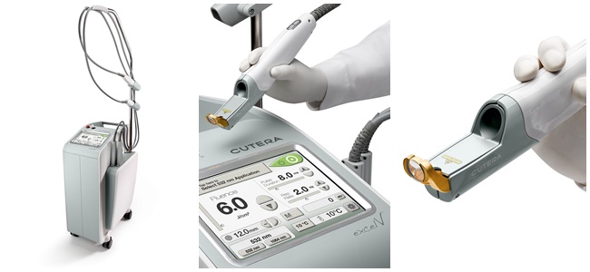 kapiliarų šalinimas lazeriu kaune